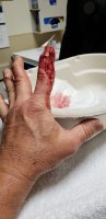 finger injury.jpg